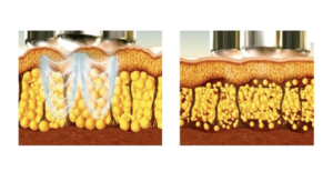 Ondas de ultrassom rompem células adiposas